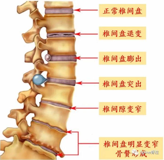 腰间盘突出创新疗法，引领康复希望之光，突破传统治疗界限